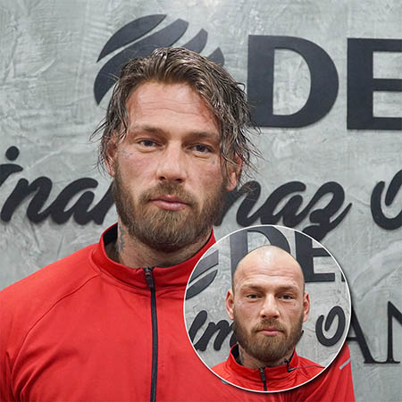 protez saç dazlak model