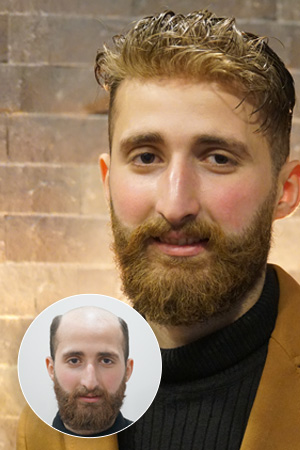 protez saçın avantajları